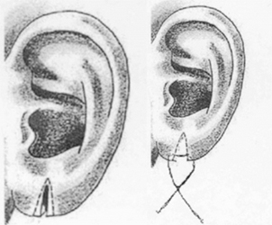 Surgery-split-or-torn-earlobes